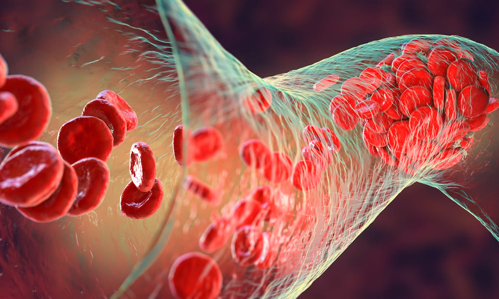 Phil Mullan Coagulation Cascade